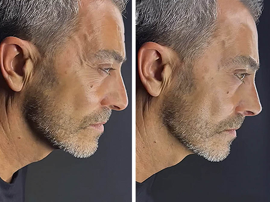 armonización facial hombre
