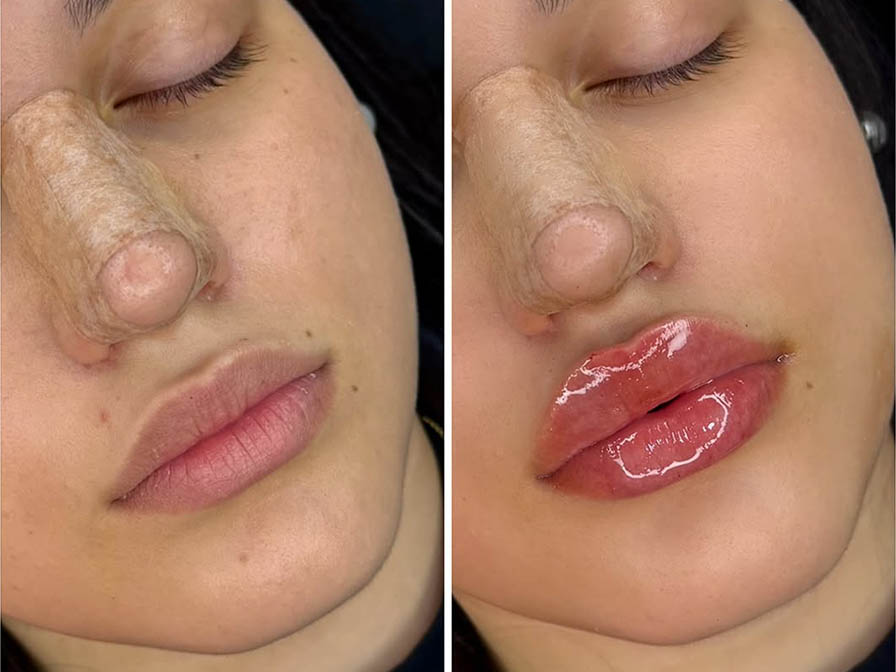 labios acido hialurónico