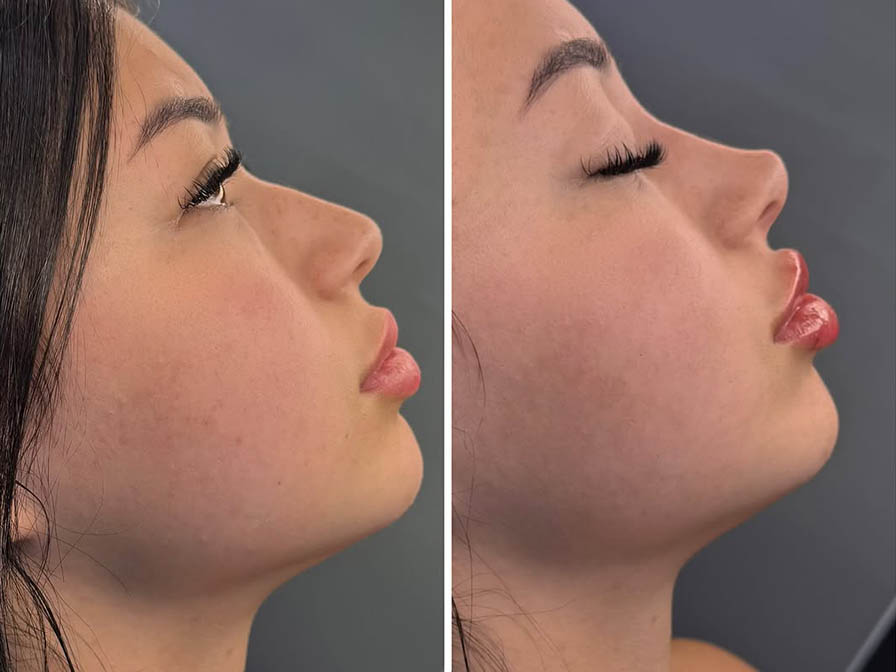 rinomodelación y labios con acido hialurónico